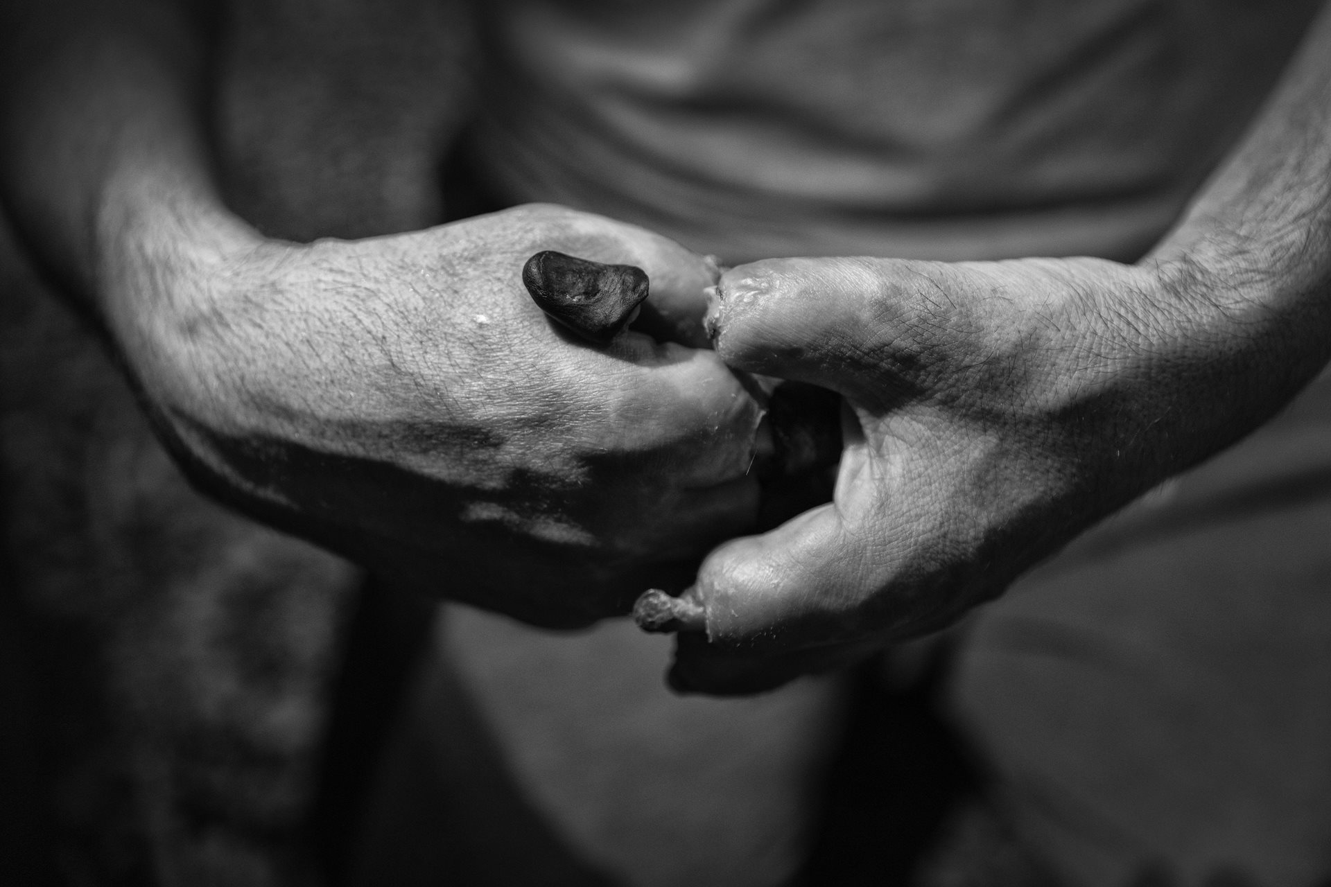 Ahmad (41) lost all his fingers to frostbite after losing his way in the mountains while carrying goods across the border, in Kurdistan, Iran. Experiencing extreme poverty, he was unable to seek medical help for more than three months, missing the opportunity for potential recovery.&nbsp;