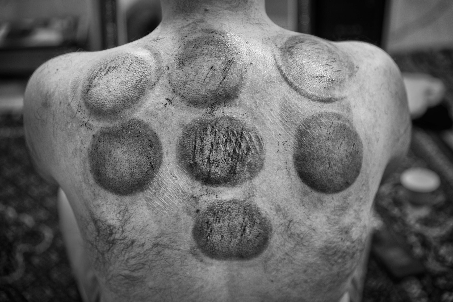 Some kolbars in Kurdistan, Iran, undergo cupping every few months, believing that the ancient therapy of applying suction to the skin using heated cups not only removes excess blood from their bodies but also stimulates the creation of new blood, providing the strength they need to carry their heavy loads.&nbsp;