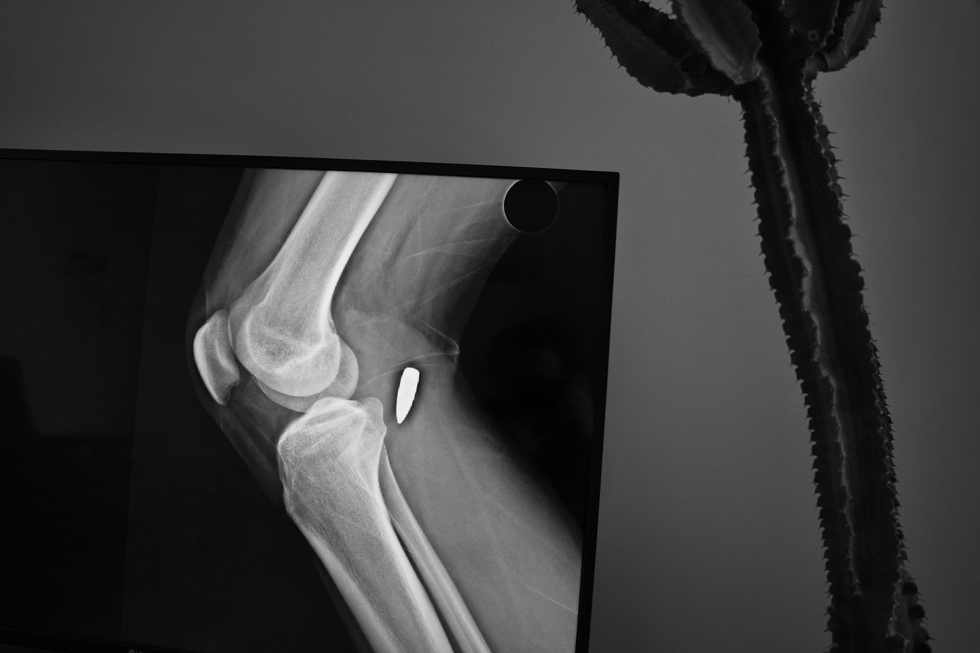 An X-ray reveals a bullet lodged in the leg of a 21-year-old kolbar from Baneh, Kurdistan, Iran, &nbsp;who was shot by border patrol forces while crossing the Iraq-Iran border in June 2024. Each year, hundreds of kolbars are killed or wounded by direct gunfire from the border patrols along the route.&nbsp;