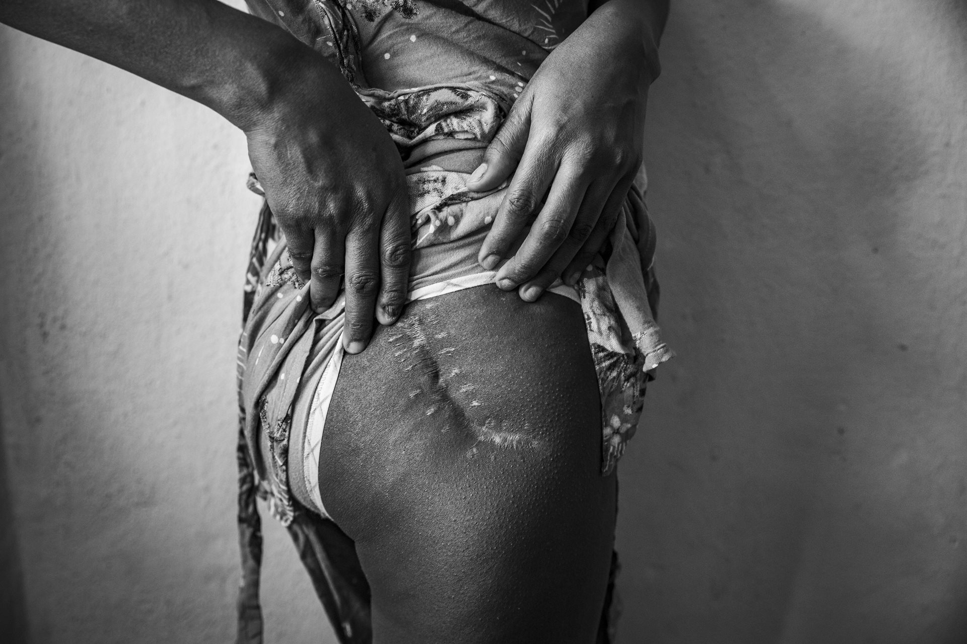 Zayid (23, not her real name) shows a scar left by a bullet, in Addis Ababa, Ethiopia. Zayid was raped at a refugee camp in Amhara. When fleeing to Addis Ababa with her family, she and her sister were shot and wounded by Amhara soldiers.