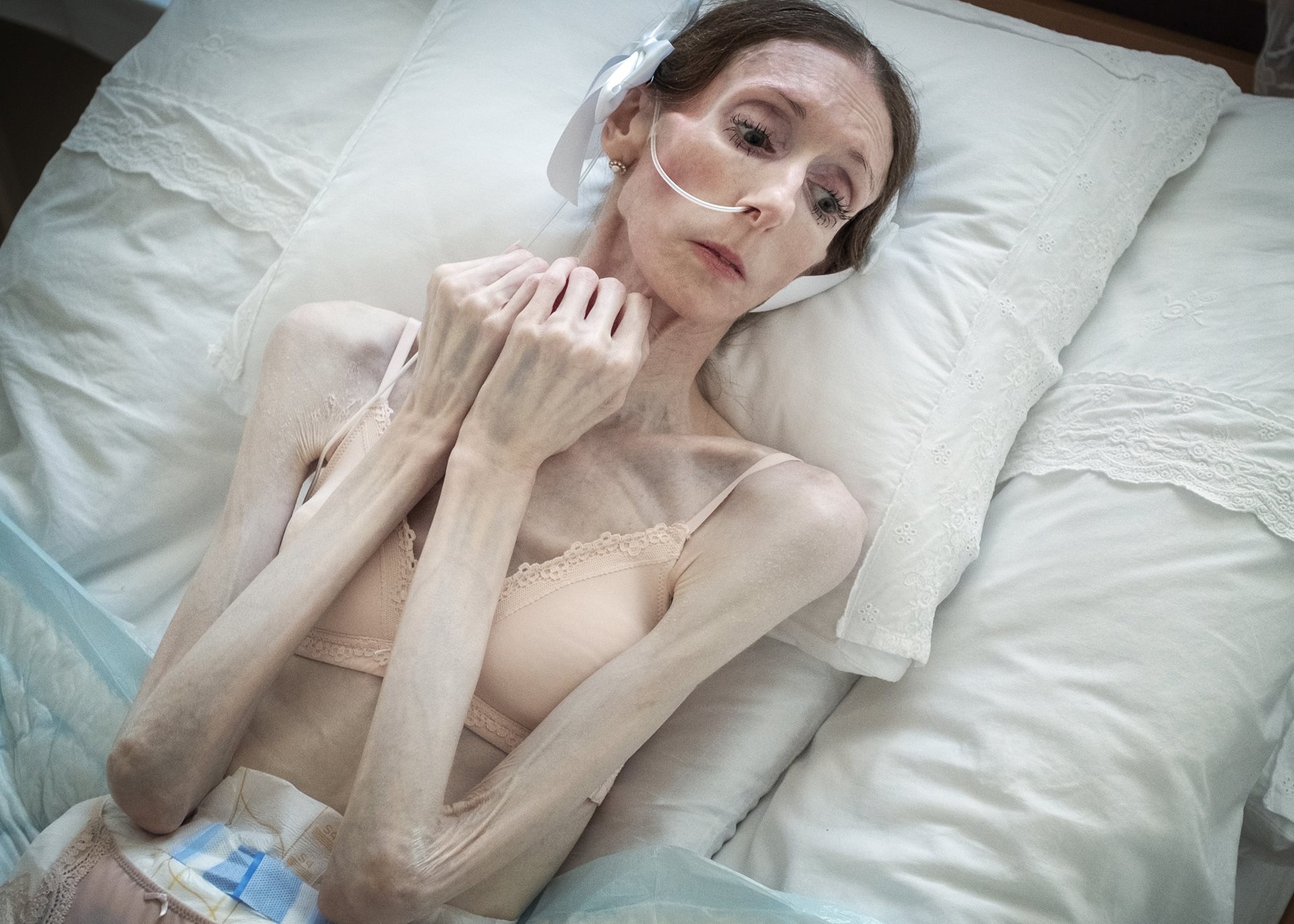 Engla Louise in her bed at home in Linköping, Sweden. At age ten, she sought psychiatric care accompanied by her mother, but was considered too young to receive treatment for anorexia.