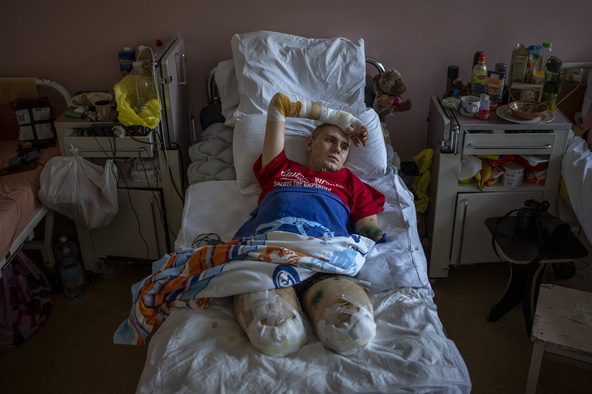 <p>Anton Gladun (22) lies on his bed in a hospital in Cherkasy, Ukraine. Anton, a military medic deployed on the front line in eastern Ukraine, lost both legs and the left arm in an explosion on 27 March.</p>
